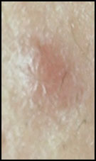 papule acné